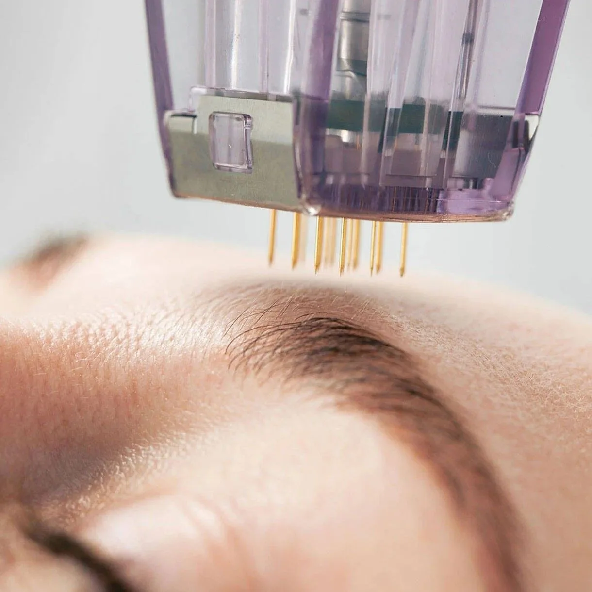 Morpheus8 RF microneedling