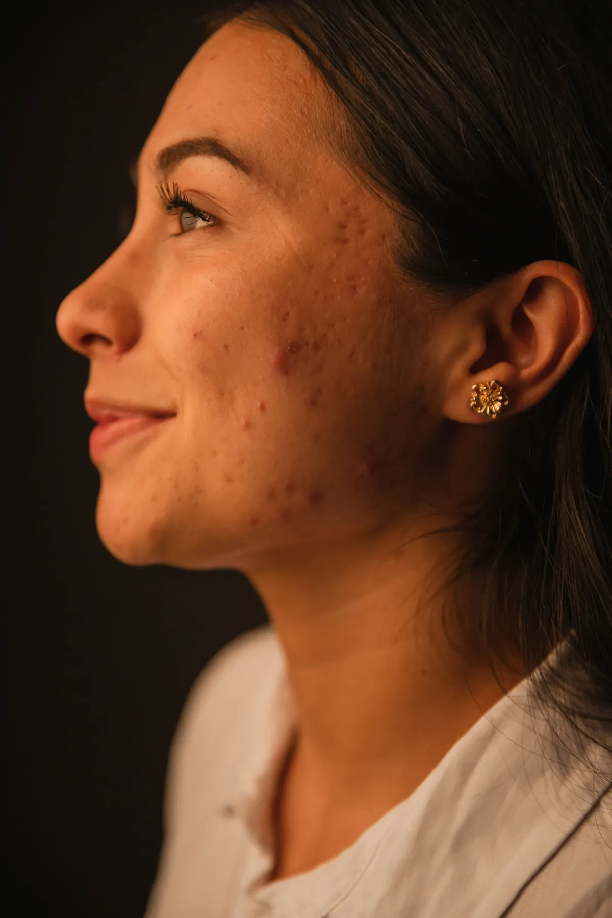 A young woman with acne, smiling