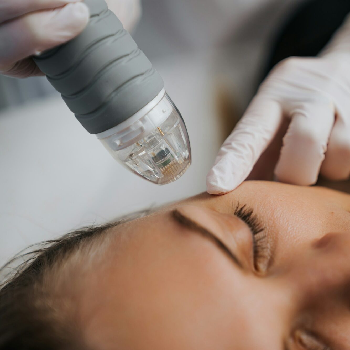 Liquid vs Traditional Microneedling: Which You Need